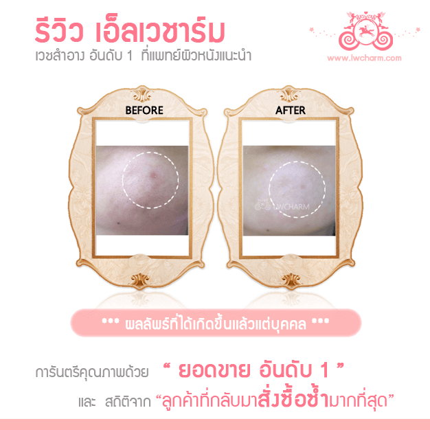 Lw Charm, เอ็ลเวชาร์ม,บอกลาสิว,เผยผิวเนียนใส,สยบทุกปํญหาผิว,เพื่อผิวสวยใส,สุขภาพดีในระยะยาว